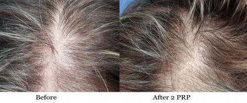 PRP Hair Treatments Before & After Gallery - Patient 58214349 - Image 2