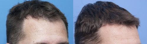 NeoGraft Hair Restoration Before & After Gallery - Patient 58214348 - Image 3