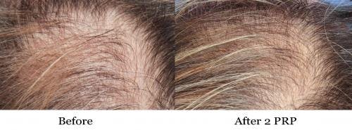 PRP Hair Treatments Before & After Gallery - Patient 58214349 - Image 3
