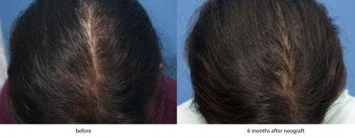 NeoGraft Hair Restoration Before & After Gallery - Patient 58214350 - Image 1