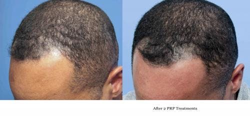 PRP Hair Treatments Gallery - Patient 58214351 - Image 1