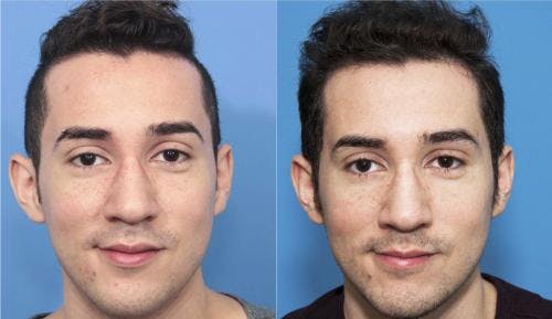 NeoGraft Hair Restoration Before & After Gallery - Patient 58214352 - Image 1