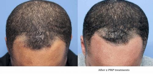 PRP Hair Treatments Before & After Gallery - Patient 58214351 - Image 2