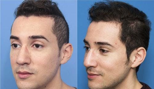 NeoGraft Hair Restoration Before & After Gallery - Patient 58214352 - Image 2