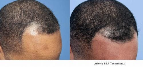 PRP Hair Treatments Before & After Gallery - Patient 58214351 - Image 3