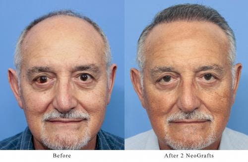 NeoGraft Hair Restoration Before & After Gallery - Patient 58214360 - Image 1