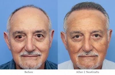 NeoGraft Hair Restoration Before & After Gallery - Patient 58214360 - Image 1