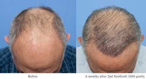 NeoGraft Hair Restoration Before & After Gallery - Patient 58214360 - Image 2