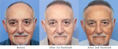 NeoGraft Hair Restoration Before & After Gallery - Patient 58214360 - Image 3