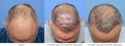 NeoGraft Hair Restoration Before & After Gallery - Patient 58214360 - Image 4