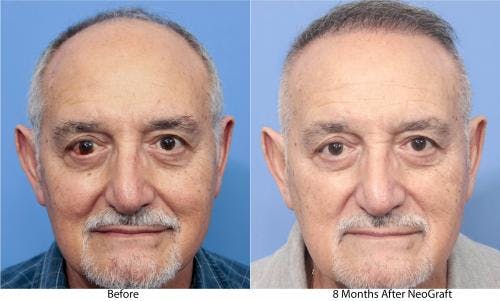 NeoGraft Hair Restoration Before & After Gallery - Patient 58214360 - Image 5