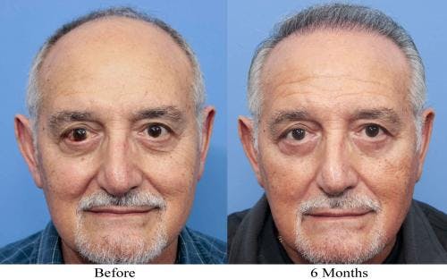 NeoGraft Hair Restoration Before & After Gallery - Patient 58214360 - Image 6