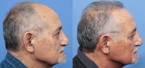 NeoGraft Hair Restoration Before & After Gallery - Patient 58214360 - Image 7