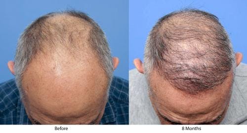 NeoGraft Hair Restoration Before & After Gallery - Patient 58214360 - Image 9