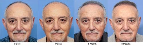 NeoGraft Hair Restoration Before & After Gallery - Patient 58214360 - Image 10