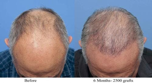 NeoGraft Hair Restoration Before & After Gallery - Patient 58214360 - Image 11