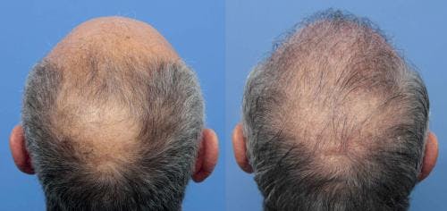 NeoGraft Hair Restoration Before & After Gallery - Patient 58214360 - Image 12