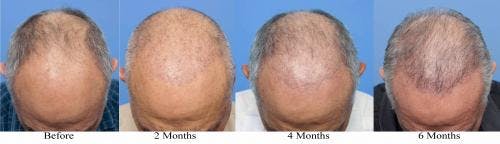 NeoGraft Hair Restoration Before & After Gallery - Patient 58214360 - Image 13