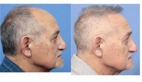 NeoGraft Hair Restoration Before & After Gallery - Patient 58214360 - Image 14