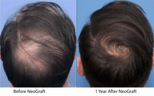 NeoGraft Hair Restoration Before & After Gallery - Patient 58214361 - Image 1