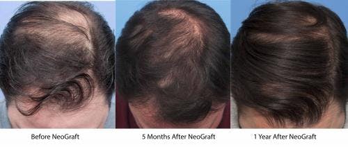 NeoGraft Hair Restoration Before & After Gallery - Patient 58214361 - Image 3