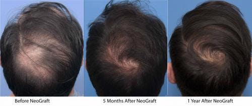 NeoGraft Hair Restoration Before & After Gallery - Patient 58214361 - Image 4