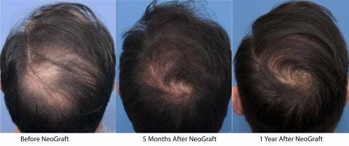 NeoGraft Hair Restoration Before & After Gallery - Patient 58214361 - Image 4