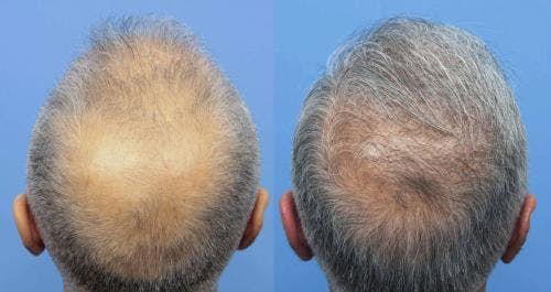 NeoGraft Hair Restoration Before & After Gallery - Patient 58214363 - Image 1