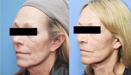 Contour TRL Laser Before & After Gallery - Patient 58214362 - Image 2