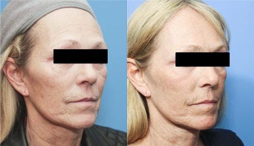 Contour TRL Laser Before & After Gallery - Patient 58214362 - Image 3
