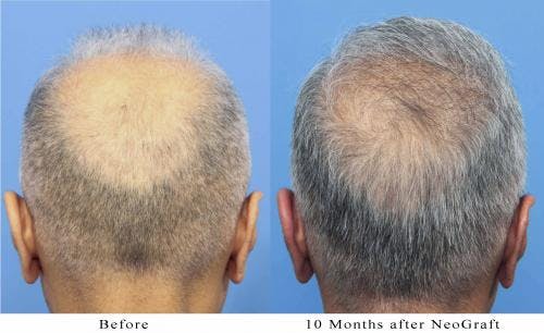 NeoGraft Hair Restoration Before & After Gallery - Patient 58214363 - Image 2