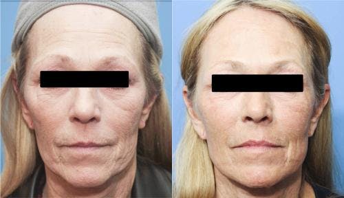 Contour TRL Laser Before & After Gallery - Patient 58214362 - Image 1