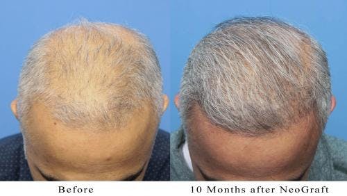 NeoGraft Hair Restoration Before & After Gallery - Patient 58214363 - Image 3