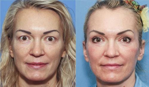 Contour TRL Laser Before & After Gallery - Patient 58214364 - Image 1