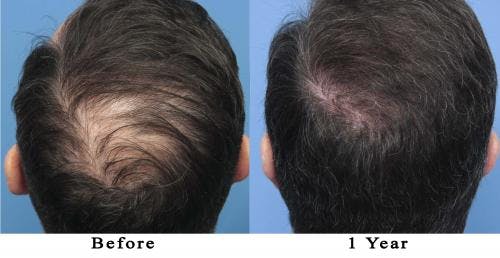 NeoGraft Hair Restoration Before & After Gallery - Patient 58214366 - Image 2