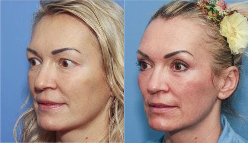 Contour TRL Laser Before & After Gallery - Patient 58214364 - Image 2