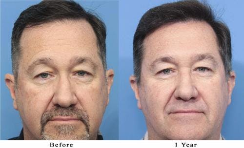 NeoGraft Hair Restoration Before & After Gallery - Patient 58214366 - Image 3