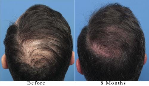 NeoGraft Hair Restoration Before & After Gallery - Patient 58214366 - Image 4