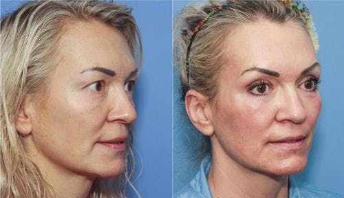 Contour TRL Laser Before & After Gallery - Patient 58214364 - Image 3
