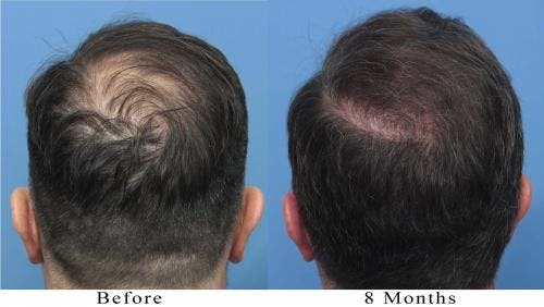 NeoGraft Hair Restoration Before & After Gallery - Patient 58214366 - Image 5