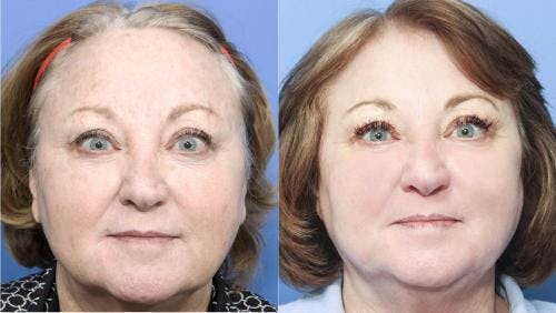 Contour TRL Laser Before & After Gallery - Patient 58214365 - Image 1