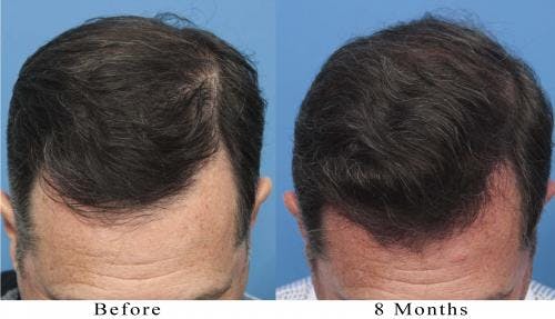 NeoGraft Hair Restoration Before & After Gallery - Patient 58214366 - Image 6