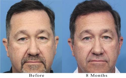 NeoGraft Hair Restoration Before & After Gallery - Patient 58214366 - Image 7