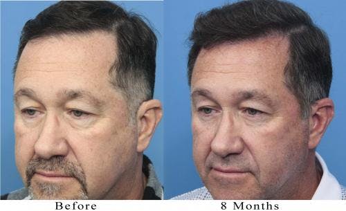 NeoGraft Hair Restoration Before & After Gallery - Patient 58214366 - Image 1