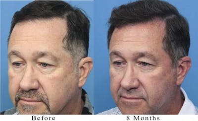 NeoGraft Hair Restoration Before & After Gallery - Patient 58214366 - Image 1