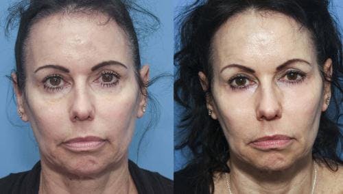 Contour TRL Laser Before & After Gallery - Patient 58214367 - Image 3