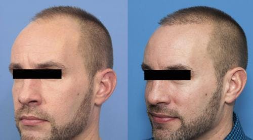 NeoGraft Hair Restoration Before & After Gallery - Patient 58214369 - Image 1