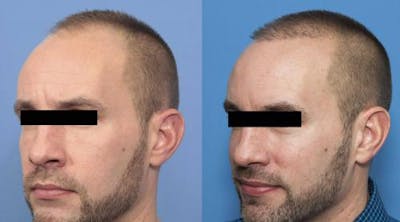 NeoGraft Hair Restoration Before & After Gallery - Patient 58214369 - Image 1