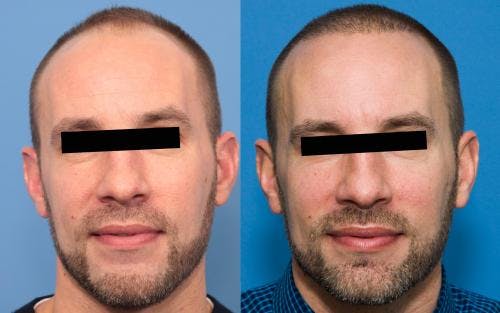 NeoGraft Hair Restoration Before & After Gallery - Patient 58214369 - Image 2