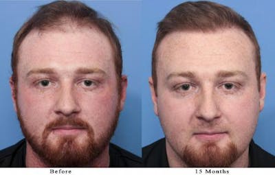 NeoGraft Hair Restoration Before & After Gallery - Patient 58214371 - Image 1